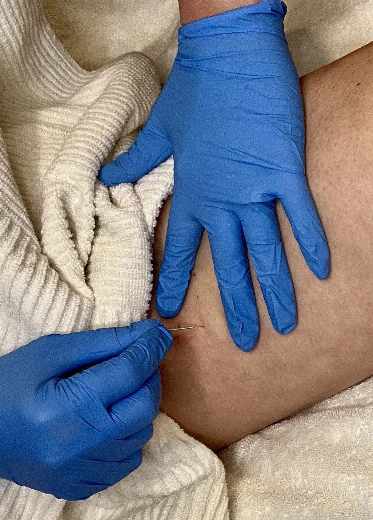 Dry needling adductor muscles