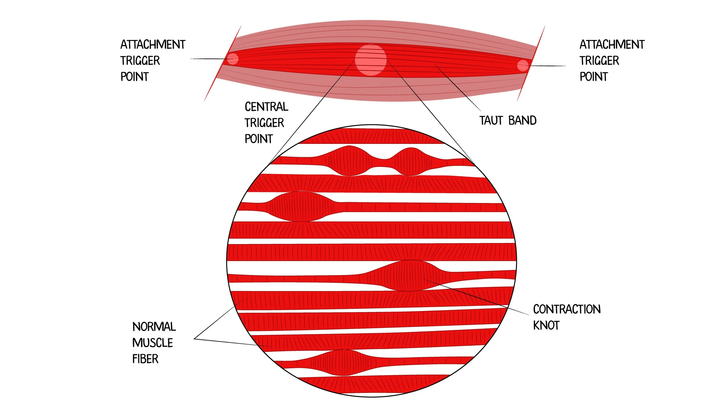 animated picture of trigger point in a muscle