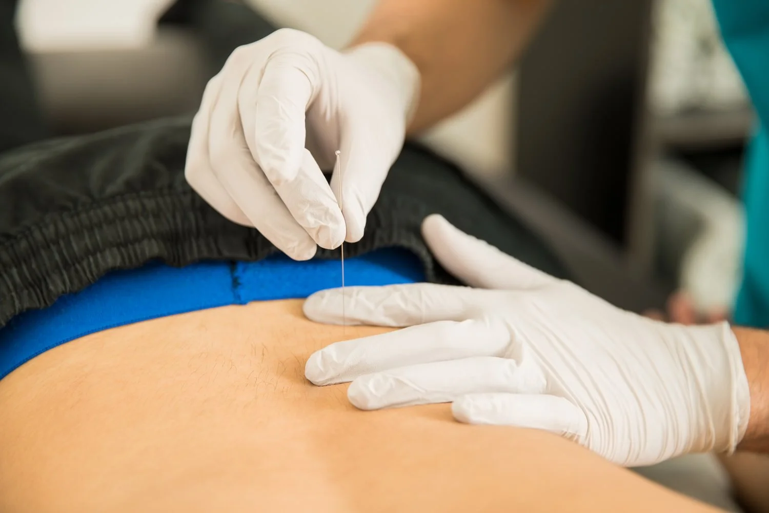 dry needling physical therapy low back Bethany Hansen edina minnesota