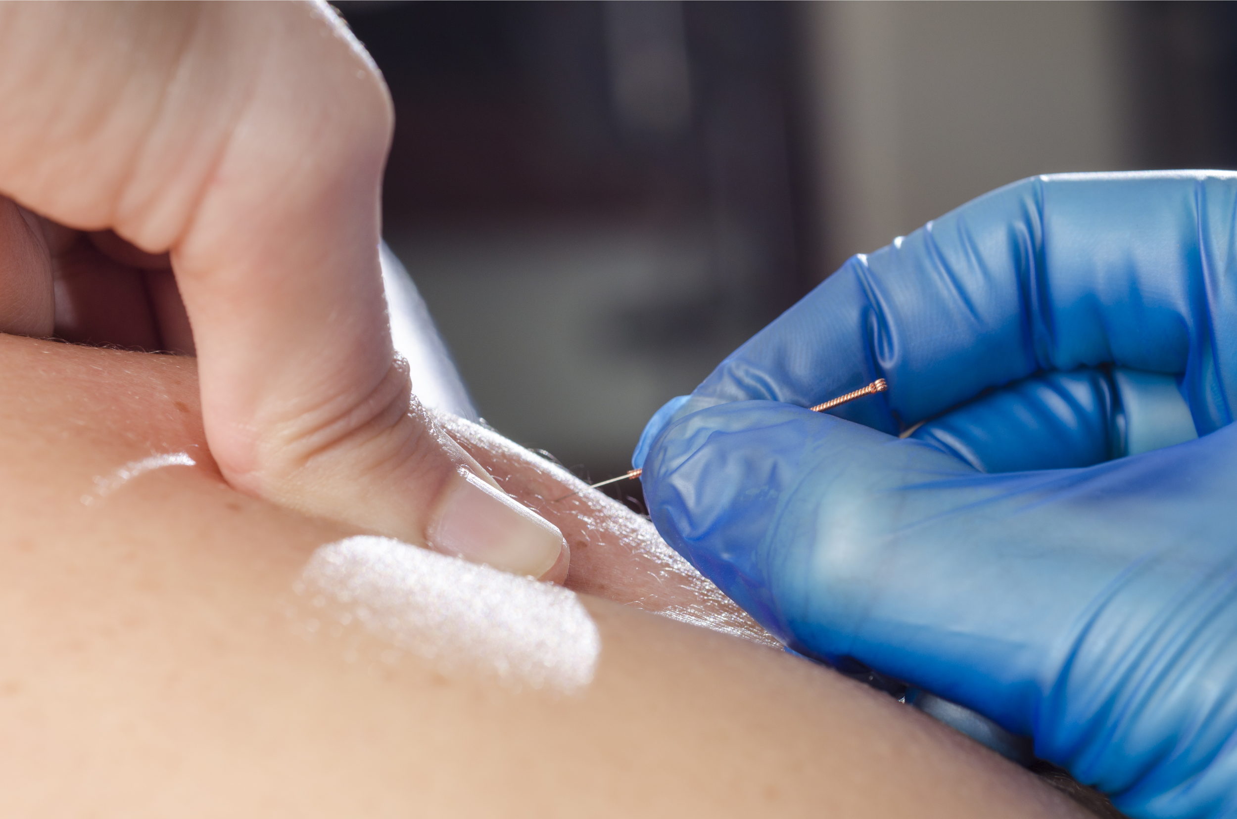 dry needling trigger point bethany hansen physical therapy edina minnesota