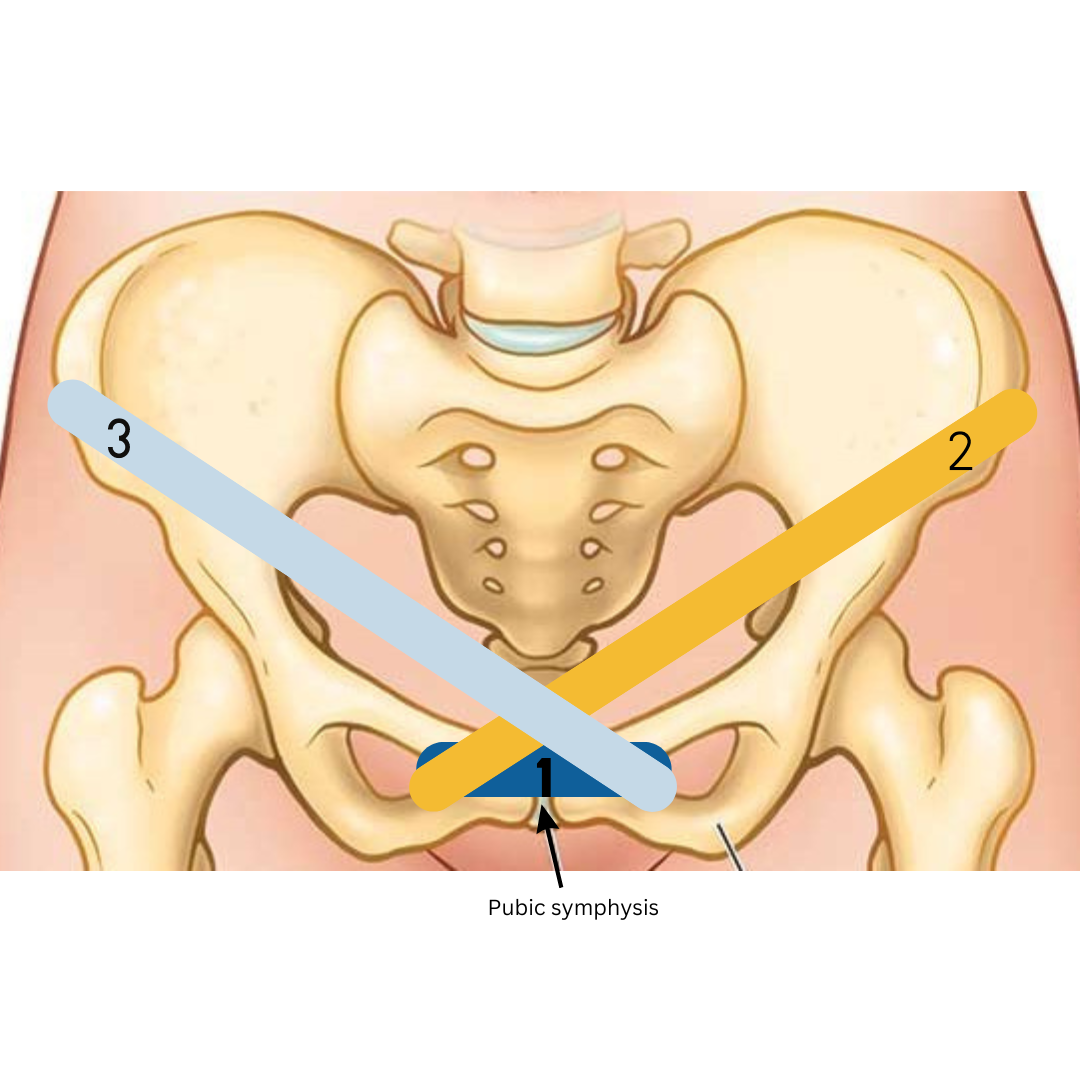 Where to put kinesiotape for pubic symphysis dysfunction