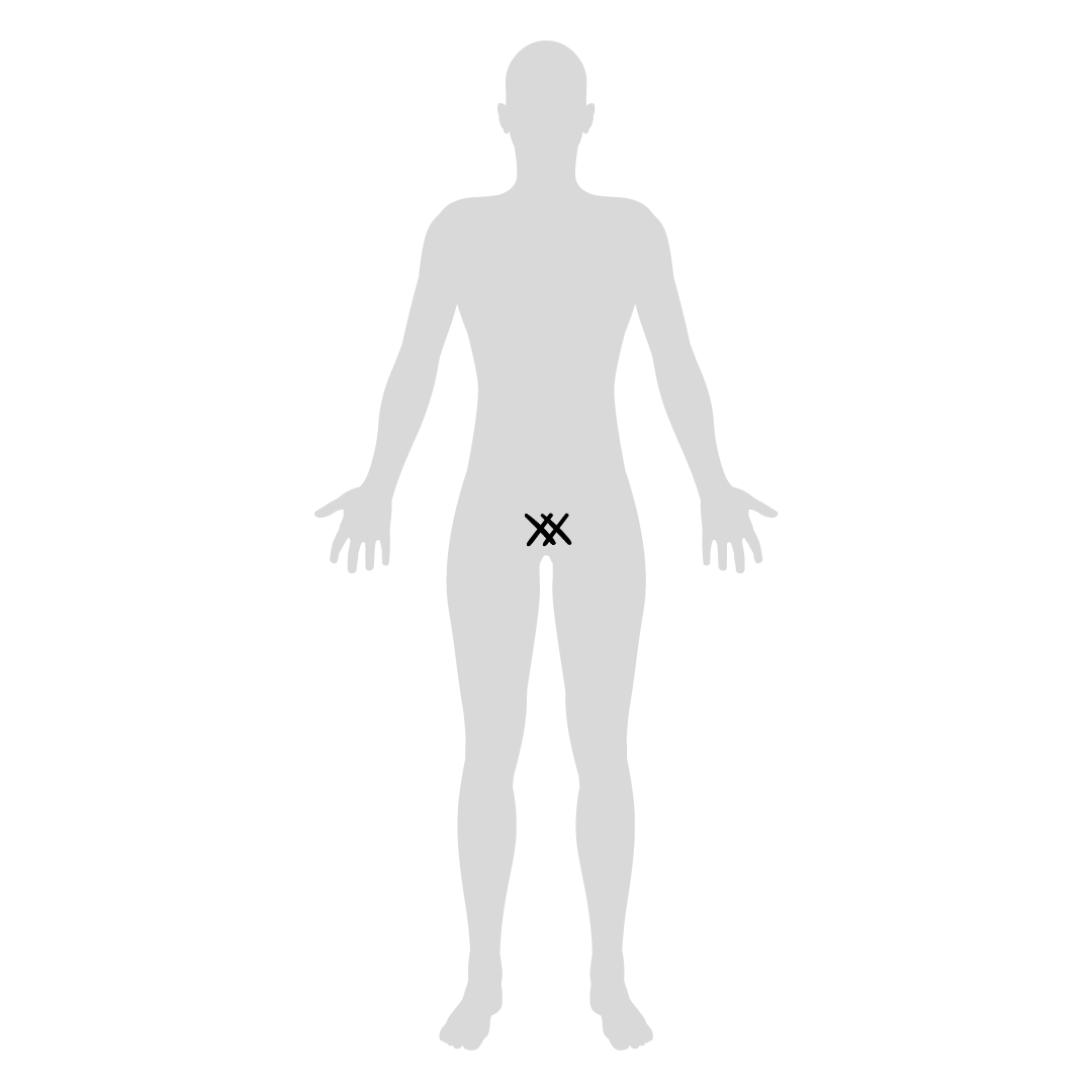 body map of pubic symphysis pain location