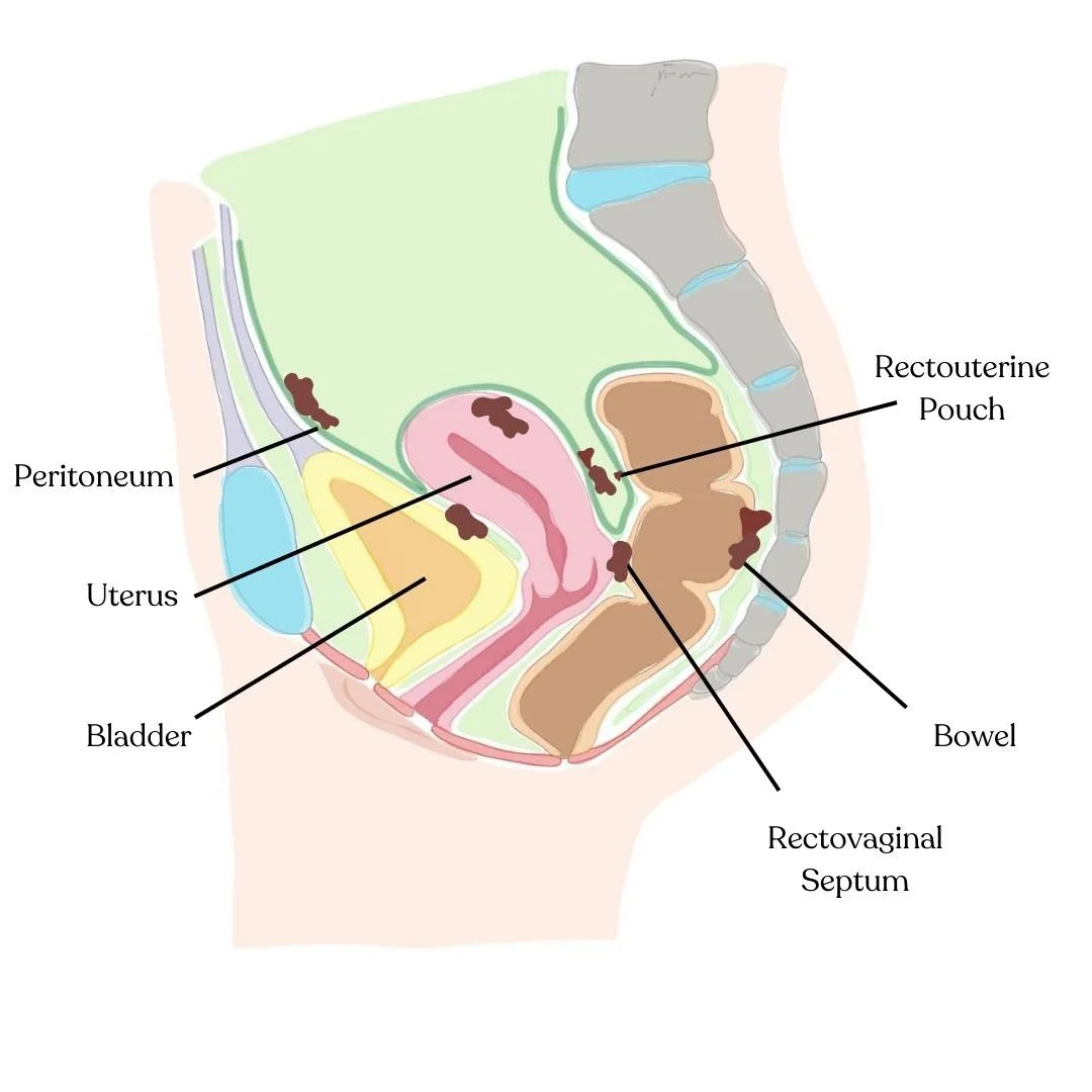 Endometriosis lesions peritoneum and pelvic cavity Bethany Hansen