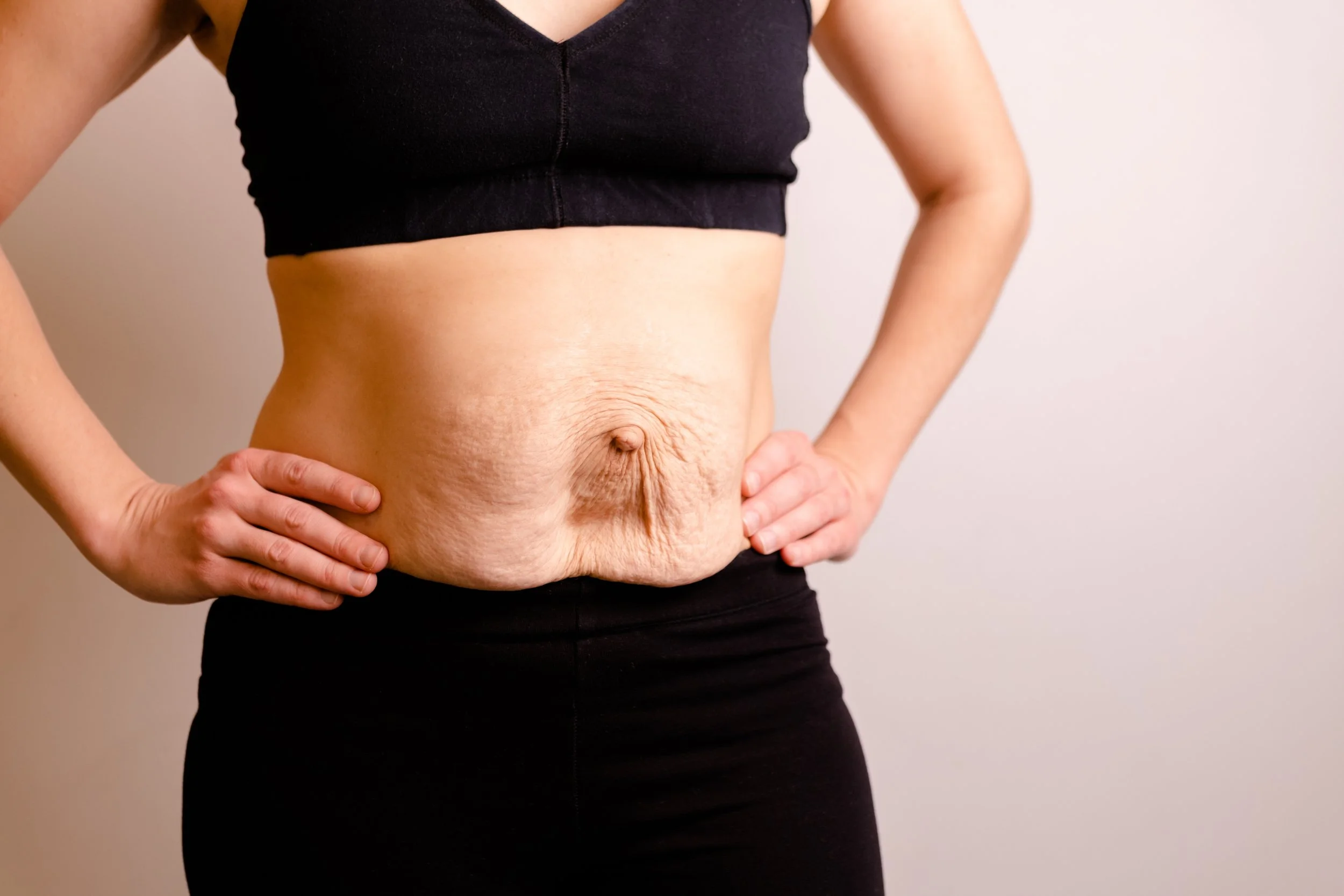 doming and coning diastasis symptoms pelvic floor physical therapy