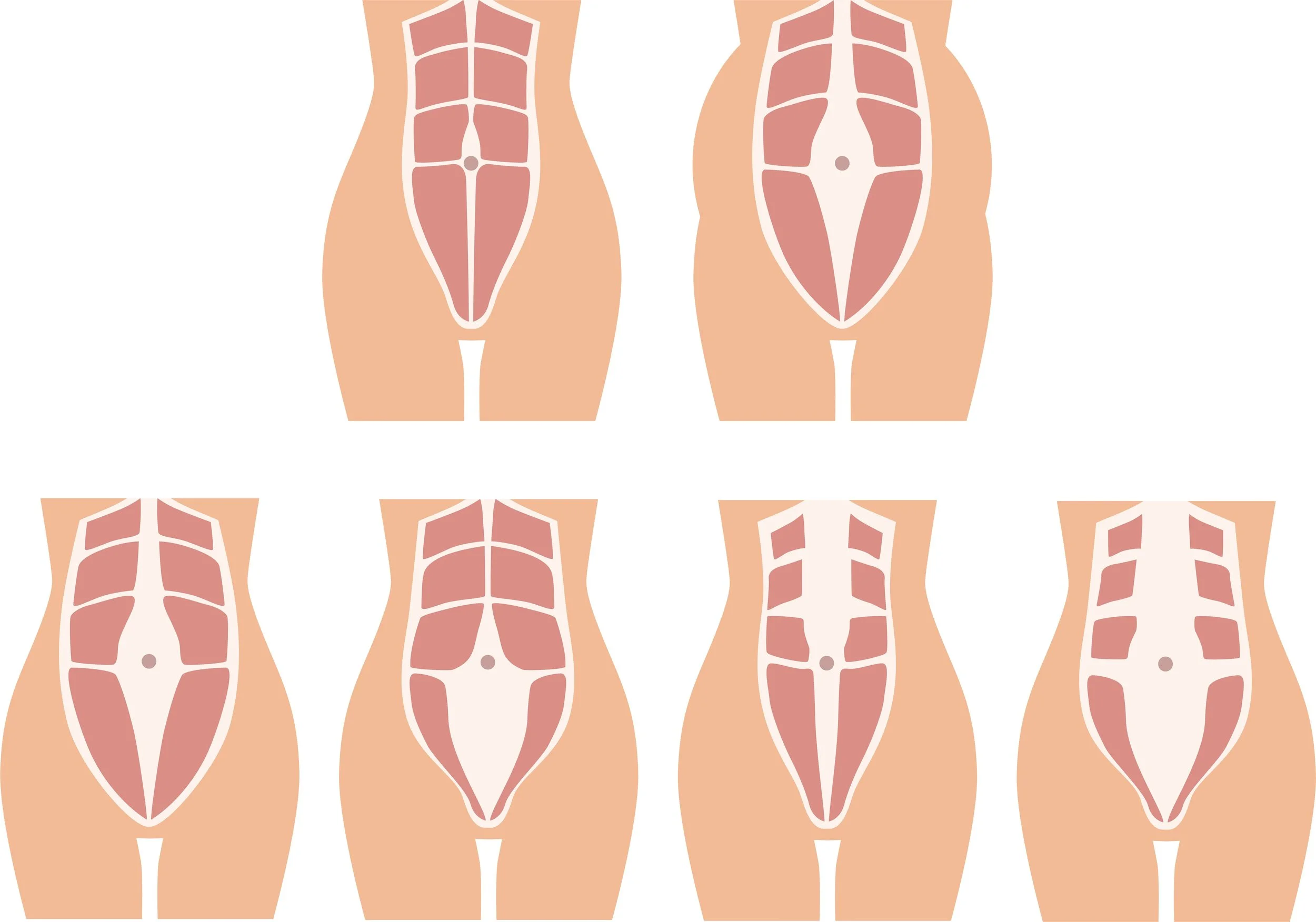 diastasis recti DRA pelvic floor physical therapy