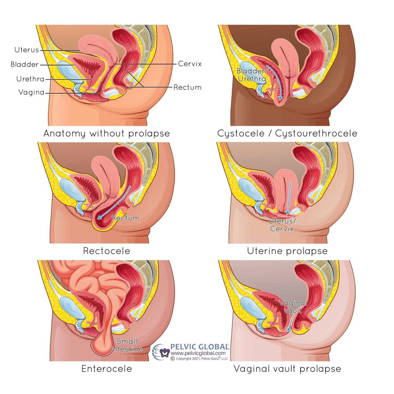 exercise with prolapse types pelvic floor physical therapy
