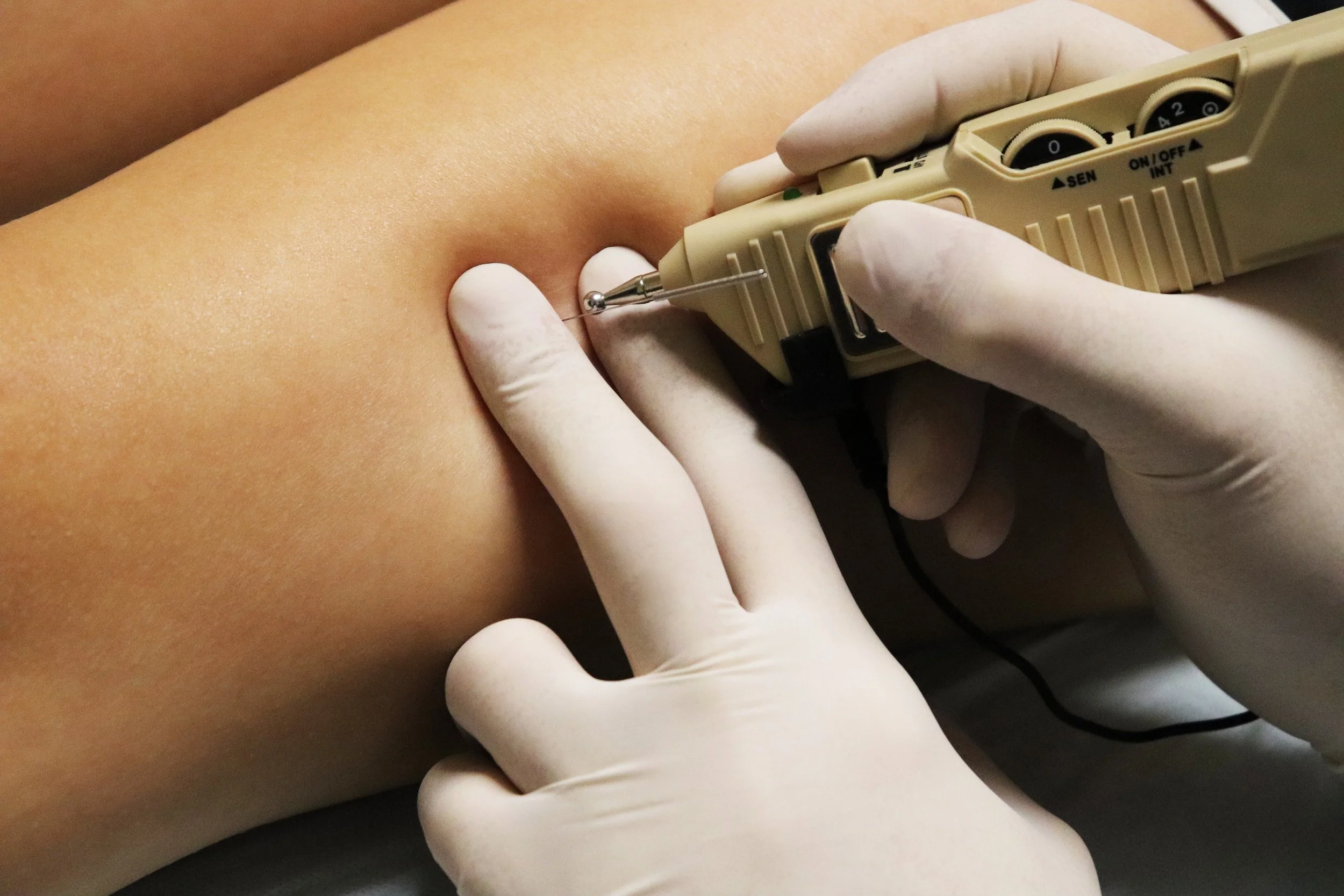 dry needling and electric stim estim