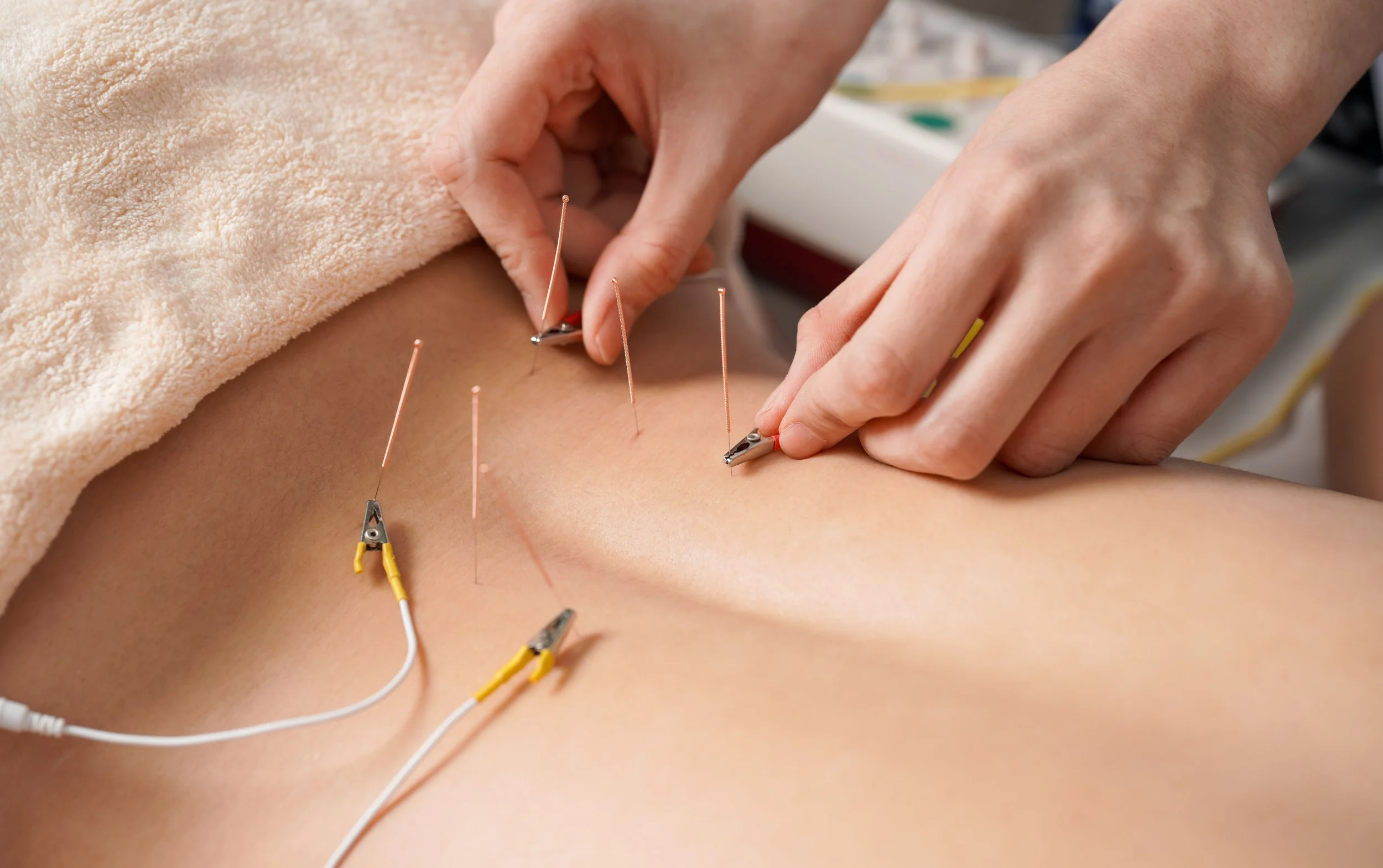 dry needling with multi channel estim unit